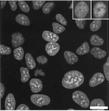 FIGURE 5 Confocal image of live MCF-7 breast tumor cells using one-photon excitation (Exλ 647nm; Emλ 680/32nm) of nuclearlocated DRAQ5 (10µM× 10min) revealing nuclear architecture and the presence of an anaphase cell. (Left insert) Nuclear retention of the dye following preparation washing and conventional paraformaldehyde fixation for the purposes of subsequent immunofluorescence colocalization analysis. (Right insert) An example of immunolocalization is shown for the expression of nuclear-located protein detected using a secondary antibody conjugated to Alexa488 (Exλ 488 nm; Emλ 522/35 nm). Size bar: 10 µm