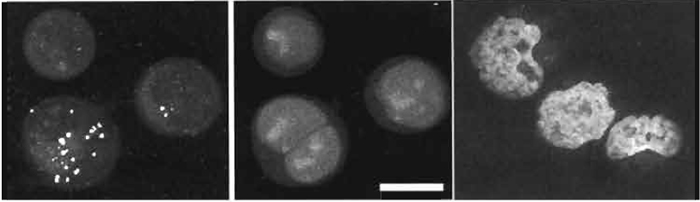 FIGURE 7 Sequential acquisition of a nuclear DNA signal (single-photon excitation of DRAQ5; Exλ 647nm; Emλ 680/32nm; 10µM× 10min; center) and the intracellular localization of a W-excitable fluorophor (two-photon excitation of the intracellular Zn2+-sensitive reporting probe Zinquin-E; Exλ 780nm; Emλ > 460nm; left) in live human B-cell lymphoma cells. Images are dual-channel projections revealing bright punctate Zinquin-Zn2+ complexes found to be exclusively cytoplasmic upon three-dimensional image reconstruction. (Right) Two-photon excitation of nuclear-located DRAQ5 using a YLF mode-locked femtosecond pulsed laser (Exλ 1047nm and far-red fluorescence) in ethanol-fixed human lymphoma cell cytocentrifuge preparations mounted in 20µM DRAQ5 in phosphate-buffered saline. Size bar: 10µm.