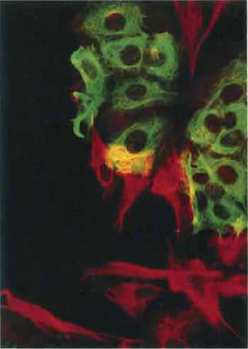 FIGURE 4 Artificial mixture of cells from the human breast carcinoma cell line MCF-7 and the human fibroblast cell line HS27 stained with an antibody to keratin (in green) and with the V9 antibody to vimentin (in red). Note that each cell type contains only a single type of intermediate filament. The yellow color results  from MCF-7 and HS27 cells that lie over each other (×150).