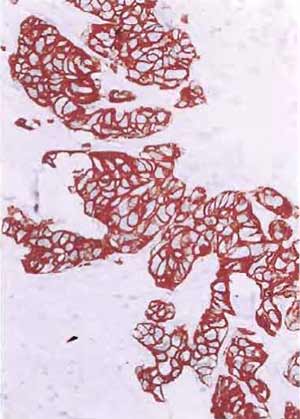 FIGURE 8 Paraffin section of human breast carcinoma stained after microwave treatment with keratin KL1 antibody in the streptavidin-biotin technique. Red tumor cells are keratin positive. Nuclei are counterstained blue (×150).