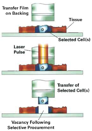 FIGURE 1 A polymer film is placed in direct contact with the tissue. A pulsed infrared laser melts the polymer, allowing the polymer to surround and embed the cells in the vicinity of the laser pulse. The polymer-cell composite is removed from the tissue section, resulting in microdissection of the cells.