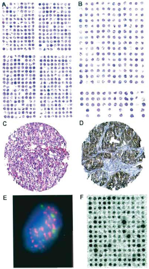 FIGURE 2 Examples of stained tissue sections. Hematoxylin and eosin (H&E)-stained sections of (A) a TMA from formalin-fixed, paraffin-embedded tissues containing 540 tissue spots and (B) a TMA from frozen tissue containing 228 tissue spots. Each tissue spot measures 0.6 mm in diameter. Missing samples result from the sectioning/staining process or indicate samples that are already exhausted. Note that the spot-to-spot distance is larger on the frozen TMA as compared to the paraffin TMA. (C) Magnification of a H&E-stained 0.6-mm tissue spot of a bladder carcinoma. (D) Immunohistochemistry against the EGFR protein in a pharynx cancer sample using the DAKO HercepTest. (E) FISH analysis of centromere 7 (green signals) and the EGFR gene (red spots) in cell nuclei (blue staining) of a tissue spot (630x). The high number of EGFR signals indicates gene amplification. (F) RNA in situ hybridization on a frozen TMA made from breast cancer tissues. A radioactively labeled oligonucleotide was used as a probe against mRNA of a lipoprotein-binding protein. The black staining intensity indicates the level of mRNA in each tissue spot.