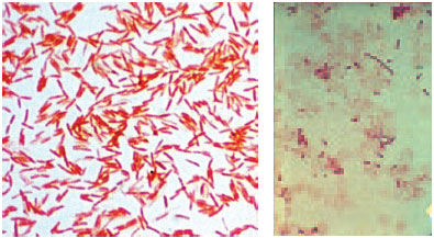 Gram-negative bacilli (Klebsiella pneumoniae) in a Gramstained smear from an agar colony (left) and a patient’s blood culture (right). In the blood specimen, the organisms are pleomorphic, varying in length from coccobacillary to filamentous.