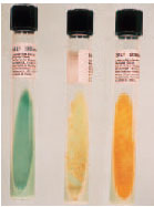 Growth of Mycobacterium spp. on Lowenstein- Jensen slants. The green tube on the left is uninoculated. The tube in the center has the characteristic dry, heaped, and rough growth of M. tuberculosis. The tube on the right shows the yellow pigmented growth of the photochromogen, M. kansasii.