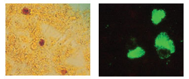 Inclusions of Chlamydia trachomatis in cell culture. The glycogen-containing inclusions stain dark brown when the cells are treated with an iodine solution (left).