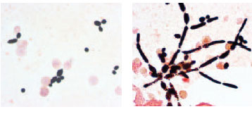 Gram stain of Candida albicans cells isolated from the blood culture of a patient. At left the yeast cells are budding, and at right, they have formed long, filamentous, irregularly staining hyphae.