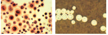 Cryptococcus neoformans in cerebrospinal fluid from a patient with AIDS. In the Gram stain at left, yeast cells are seen to stain irregularly. The orange-staining halo around some cells is the Cryptococcus capsule. In the India ink preparation at right, the cryptococcal yeast cells are surrounded by a capsule that is demarcated by the suspension of charcoal particles in the India ink.