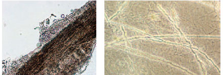 KOH preparations of a hair and skin scales from patients with tinea capitis (ringworm of the hair) and tinea corporis (ringworm of the body). On the left, many round, reproductive spores of the dermatophyte fungus are seen surrounding the hair; the filamentous hyphae invade the hair shaft. On the right, the filamentous hyphae are seen invading skin scales throughout the preparation.