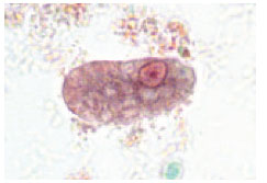 A trophozoite of Entamoeba histolytica. The characteristic circular nucleus at the top right portion of the ameba has dark chromatin evenly distributed around its edges and a centrally placed karyosome.