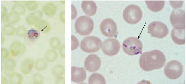 Plasmodium trophozoites in red blood cells (arrows). P. vivax at left causes the blood cell to enlarge and show characteristic stippling (Schüffner’s dots). At right, three trophozoites (ring forms) of P. falciparum in a single red blood cell. Multiply infected cells are characteristic of this malarial species; the infected cell is not enlarged and no Schüffner’s dots are present.