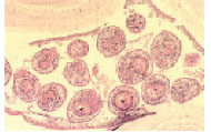 Echinococcus granulosus cyst from human liver. More than 12 larval forms of Echinococcus can be seen budding off from the thickwalled capsule.