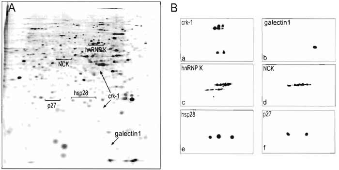 FIGURE 3 Two-dimensional ECL immunoblots of proteins from a bladder transitional cell carcinoma labelled with [35S]methionine (A) and reacted with antibody (B) against crk-1 (a), galectin 1 (b), hnRNP K (c), NCK (d), hsp28 (e), and p27 (f).