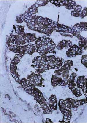 FIGURE 1 Frozen section of human breast carcinoma stained with the keratin KL1 antibody and with peroxidase-labeled second antibody. Brown tumor cells are positive for keratin. Nuclei are  counterstained blue (×150).