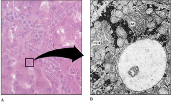 Liver cells. A, Magnified approximately 400 times through light microscopy. Note the prominently stained nucleus in each polyhedral cell. B, Portion of single liver cell, magnified approximately 5000 times by electron microscopy. A single large nucleus dominates the field; mitochondria (M), rough endoplasmic reticulum (RER), and glycogen granules (G), are also seen.