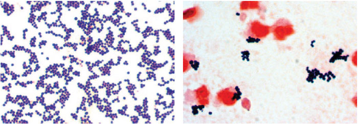 Staphylococcus aureus in a Gram-stained smear from a colony growing on agar medium (left) and from the sputum of a patient with staphylococcal pneumonia (right). The organisms are gram-positive spheres, primarily in grapelike clusters. The pink cells in the right-hand photo are neutrophils.