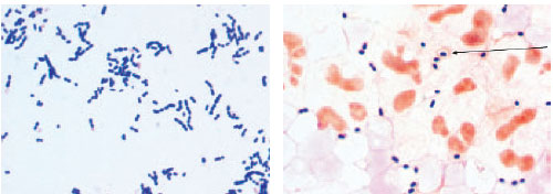 Streptococcus pneumoniae in Gram-stained smears. The organisms from a colony growing on agar medium (left) are gram positive and lancet shaped and appear in pairs and short chains. In a Gram stain of cerebrospinal fluid from a patient with pneumococcal meningitis (right), the organisms are mostly diplococci. The capsule (arrow) can be seen around some bacteria, outlined by the pink proteinaceous material of the fluid.