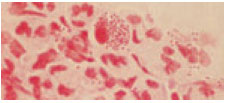 Neisseria gonorrhoeae in a Gram-stained smear from a male urethral exudate appear as gramnegative, bean-shaped diplococci.