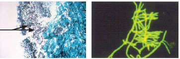 Left: Methenamine silver stain of sinus biopsy (×100). All of the black material represents the invading fungus, Aspergillus flavus. Two of the characteristic sporebearing structures can be seen on the nasal cavity side (arrows). Right: A calcofluor stain of the biopsy material as seen under an ultraviolet light source (×400).