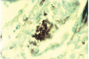 Methenamine silver stain of cyst form of Pneumocystis carinii from lung biopsy of a patient with AIDS.
