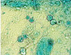 Lactophenol cotton blue preparation of Blastomyces dermatitidis growing in culture of sputum. The characteristic thickwalled, broad-based budding yeast cells are seen at the top right and bottom left of the preparation.